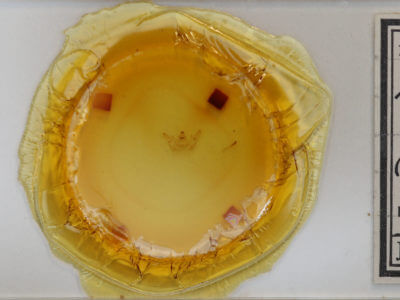 slide view of adult Xanthotype urticaria