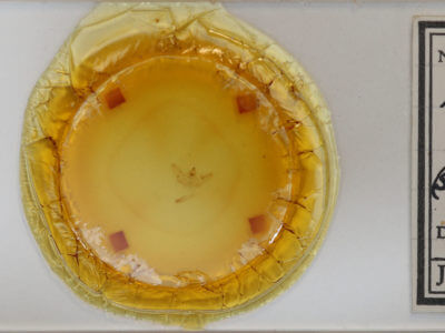 slide view of adult Xanthotype urticaria