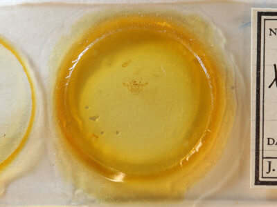 slide view of adult Xanthotype urticaria