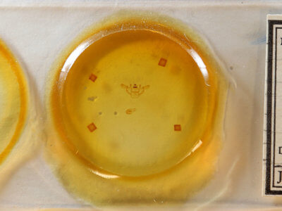 slide view of adult Xanthotype urticaria