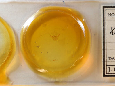 slide view of adult Xanthotype urticaria