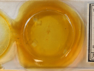 slide view of adult Xanthotype urticaria