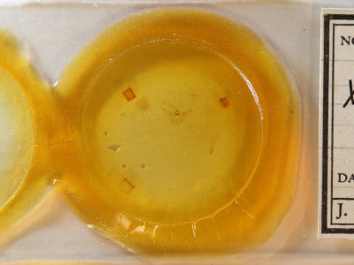 slide view of adult Xanthotype urticaria