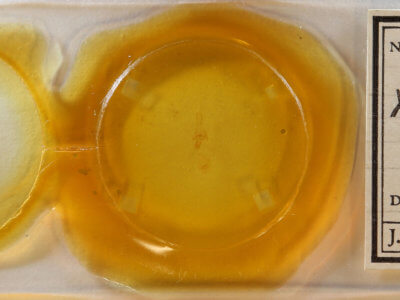 slide view of adult Xanthotype urticaria