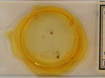 slide view of adult Argyria