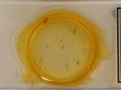 slide view of adult Argyria