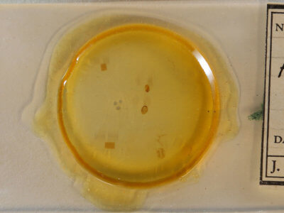 slide view of adult Argyria