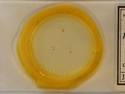 slide view of adult Argyria